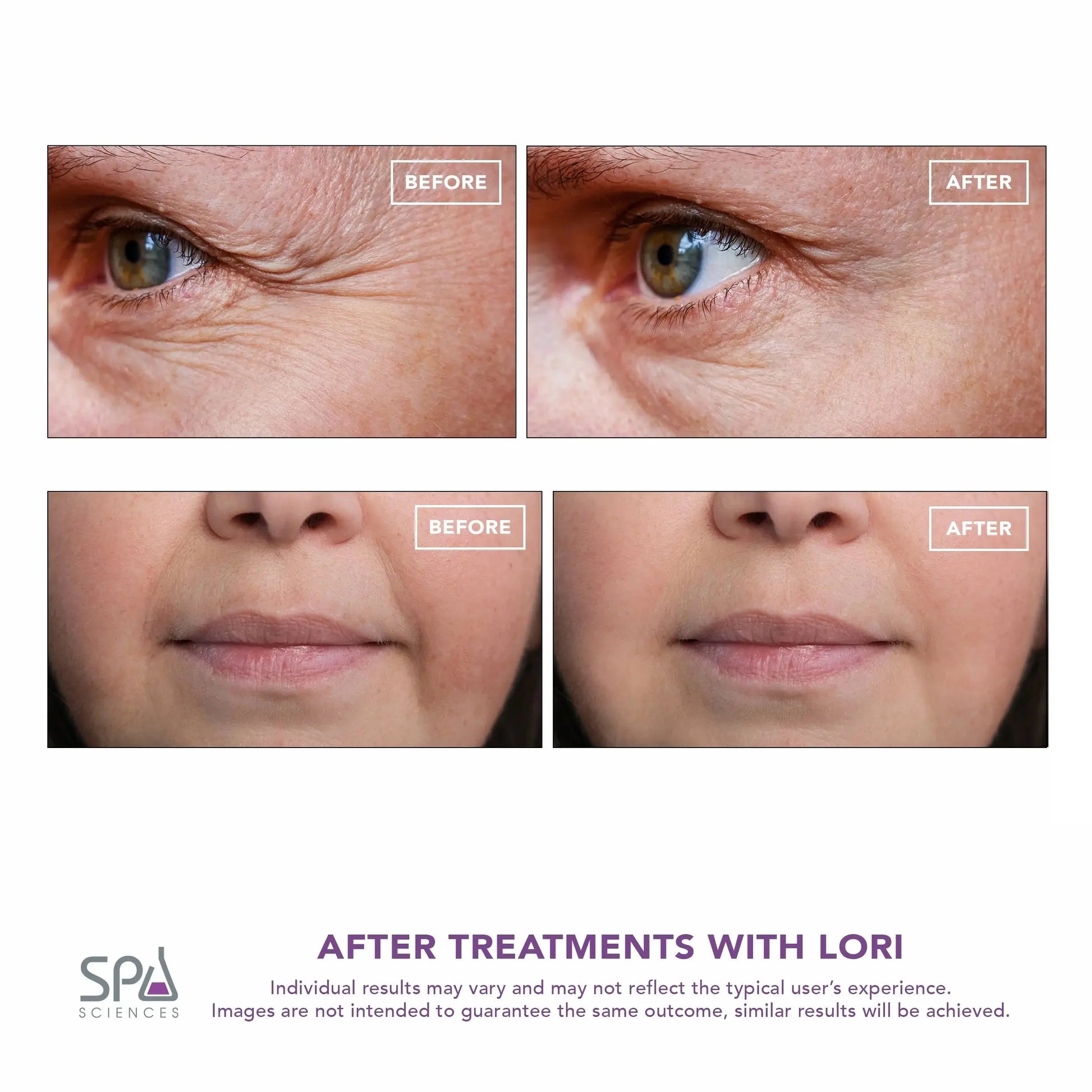 LORI Facial Lifting & Serum Infusion Wand – Sonic, Cold & Heat Therapy for Eyes & Lips, Anti-Aging & Fine Line Reducer